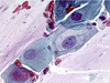 Cervical cancer symptoms