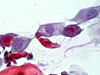 Cervical cancer symptoms