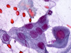 Cervical cancer symptoms