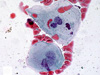 Cervical cancer symptoms